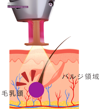GentleMax Pro Plusの脱毛のしくみ