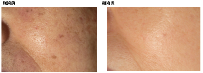 老人性色素斑の症例