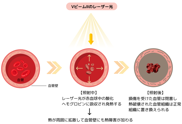 Vbeam Ⅱのレーザー光
